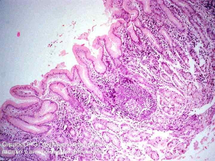 Окраска Г+Э. Хронический антральный гастрит с лимфоидными фолликулом 