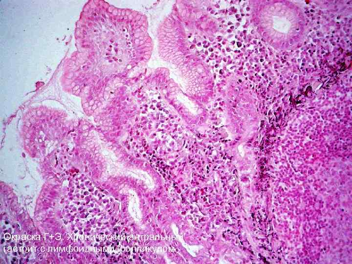 Окраска Г+Э. Хронический антральный гастрит с лимфоидными фолликулом 