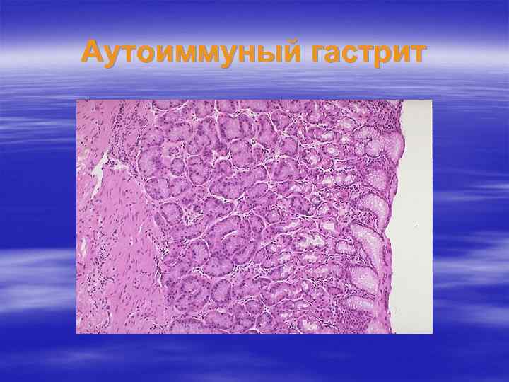 Аутоиммуный гастрит 