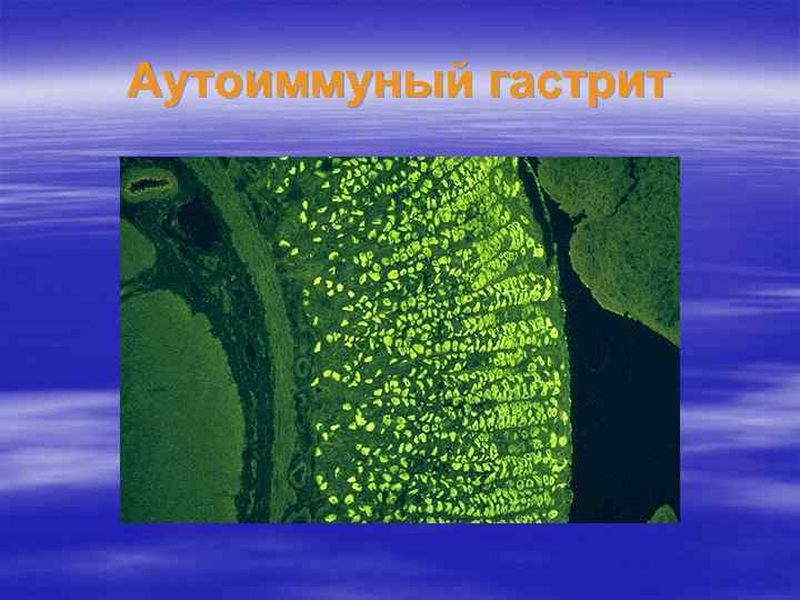 Аутоиммуный гастрит 