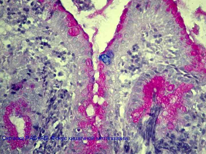 Окраска PAS+AB. Фокус кишечной метаплазии 