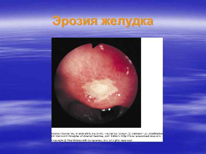 Эрозия желудка 