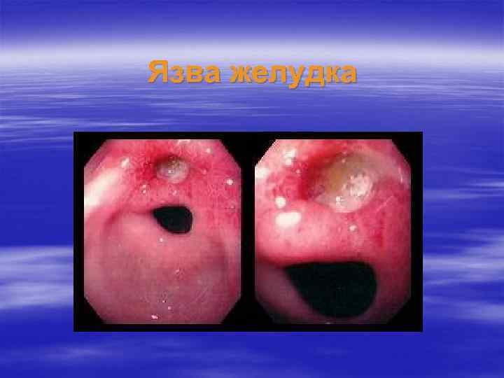 Язва желудка 