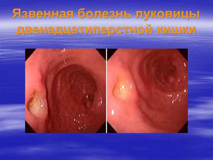 Язвенная болезнь луковицы двенадцатиперстной кишки 