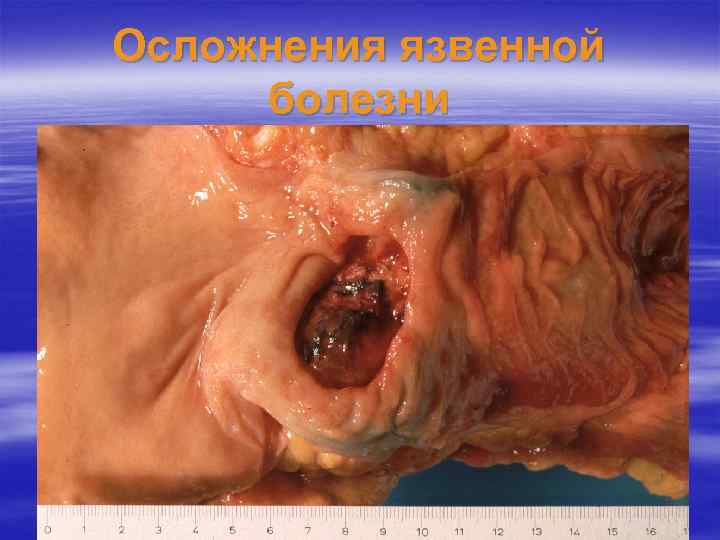 Осложнения язвенной болезни 