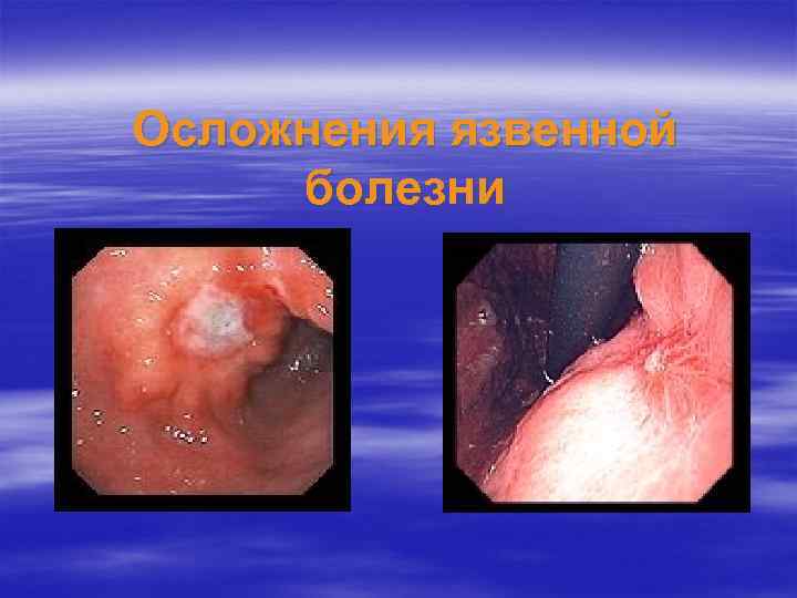 Осложнения язвенной болезни 