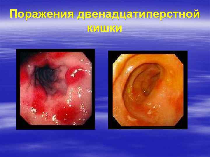 Поражения двенадцатиперстной кишки 