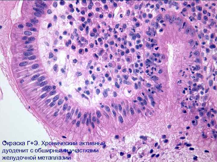 Окраска Г+Э. Хронический активный дуоденит с обширными участками желудочной метаплазии 