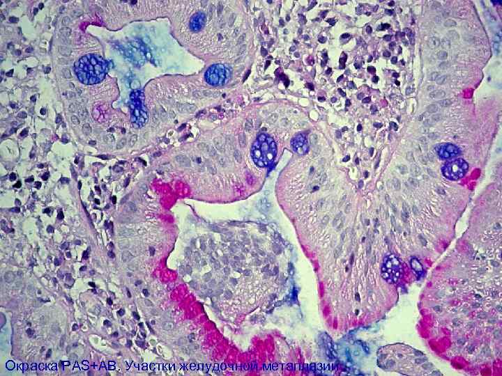 Окраска PAS+AB. Участки желудочной метаплазии 