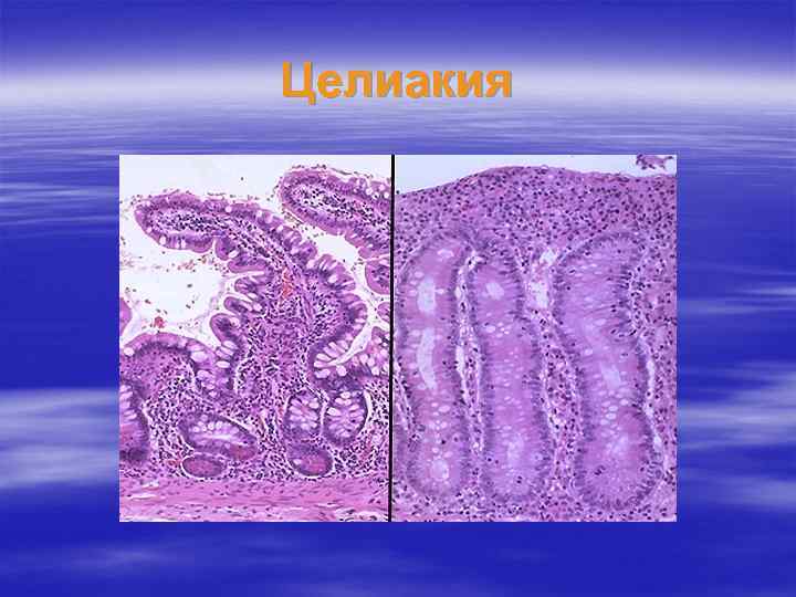 Целиакия 