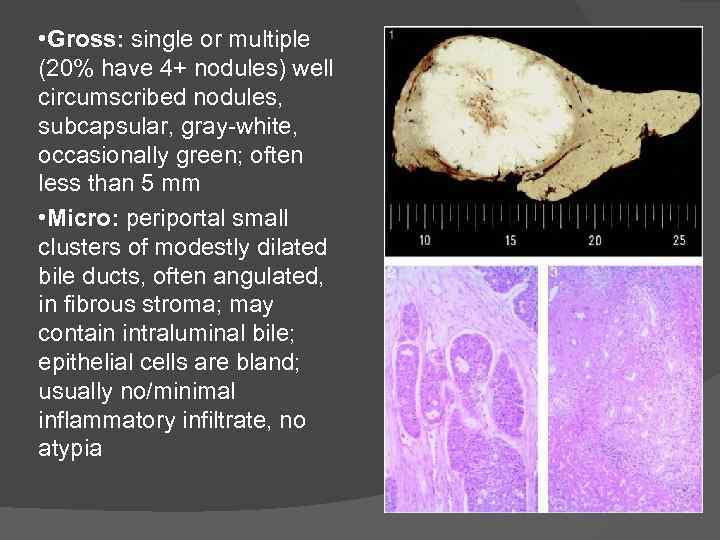  • Gross: single or multiple (20% have 4+ nodules) well circumscribed nodules, subcapsular,