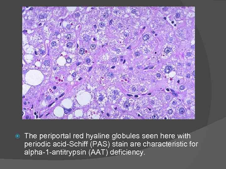  The periportal red hyaline globules seen here with periodic acid Schiff (PAS) stain