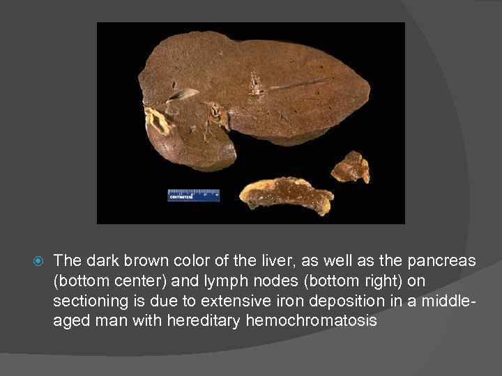  The dark brown color of the liver, as well as the pancreas (bottom