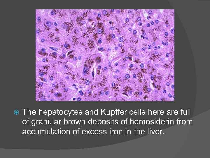  The hepatocytes and Kupffer cells here are full of granular brown deposits of