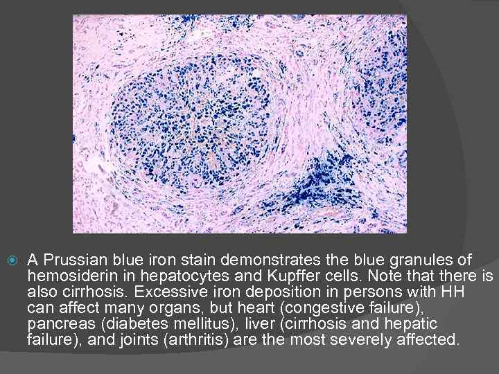  A Prussian blue iron stain demonstrates the blue granules of hemosiderin in hepatocytes