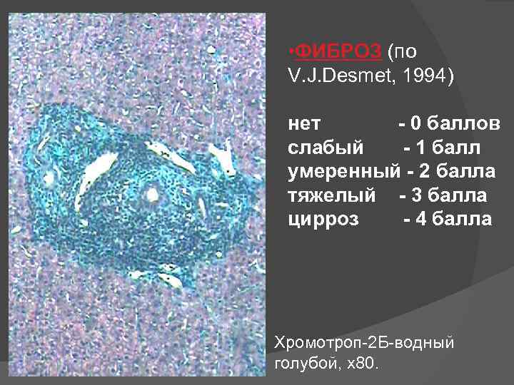  • ФИБРОЗ (по ФИБРОЗ V. J. Desmet, 1994) нет - 0 баллов слабый