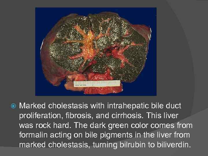  Marked cholestasis with intrahepatic bile duct proliferation, fibrosis, and cirrhosis. This liver was