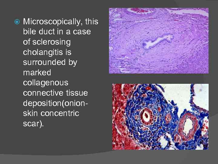  Microscopically, this bile duct in a case of sclerosing cholangitis is surrounded by