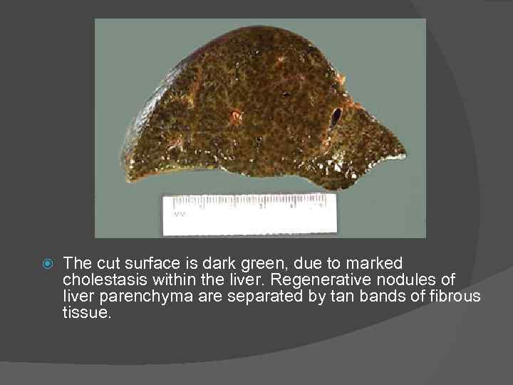  The cut surface is dark green, due to marked cholestasis within the liver.