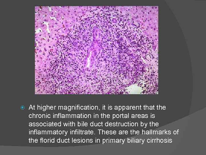  At higher magnification, it is apparent that the chronic inflammation in the portal