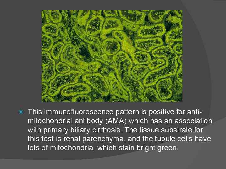  This immunofluorescence pattern is positive for anti mitochondrial antibody (AMA) which has an