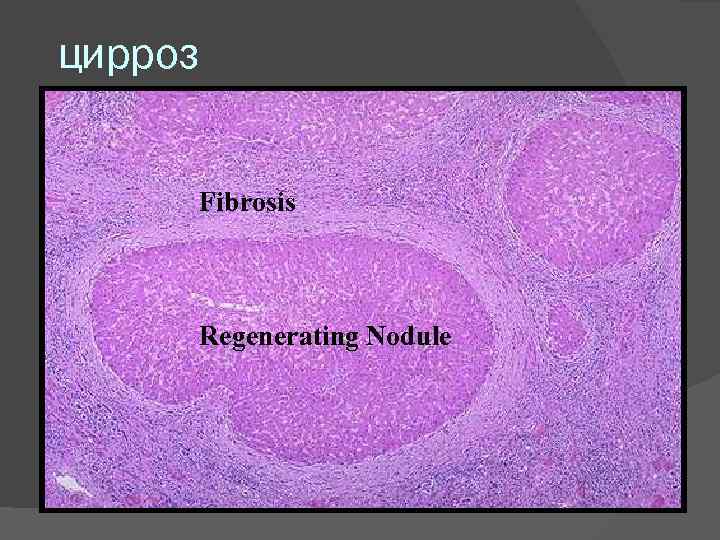 цирроз Fibrosis Regenerating Nodule 