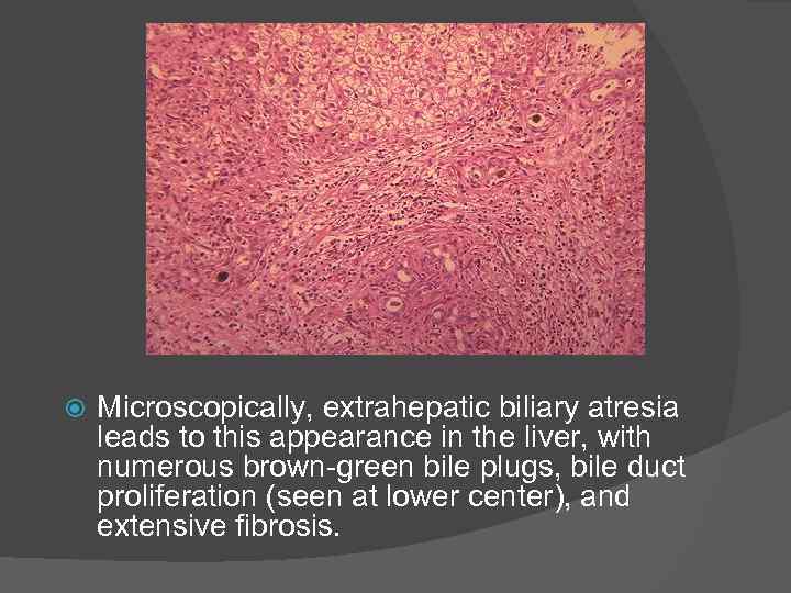  Microscopically, extrahepatic biliary atresia leads to this appearance in the liver, with numerous