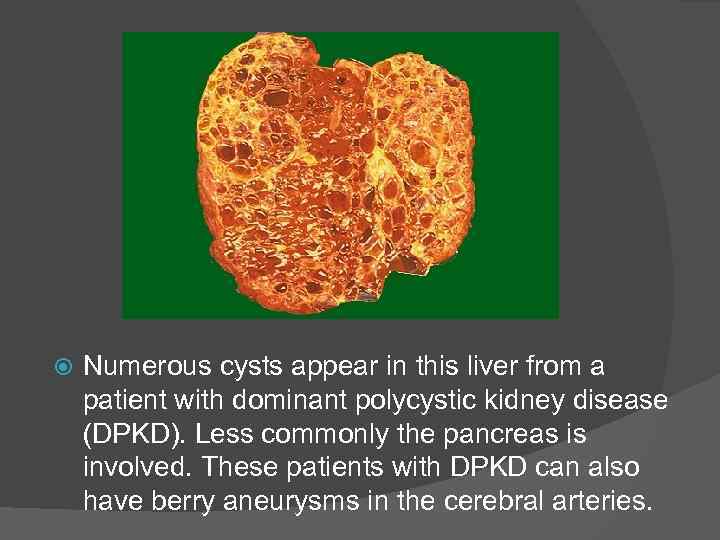  Numerous cysts appear in this liver from a patient with dominant polycystic kidney