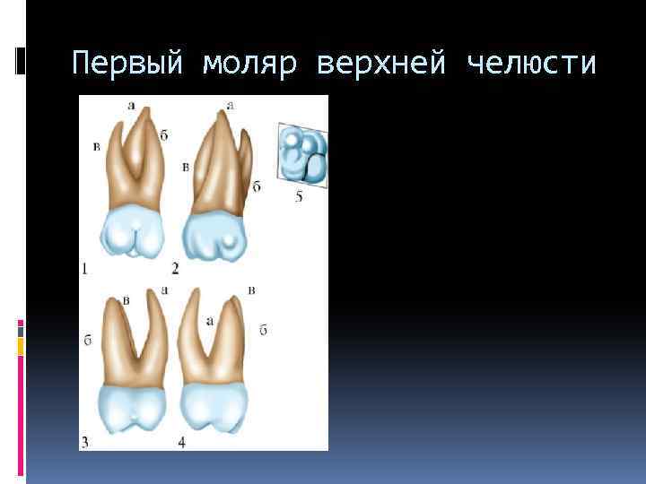 Первый моляр верхней челюсти 