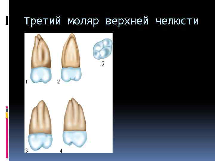 Третий моляр верхней челюсти 