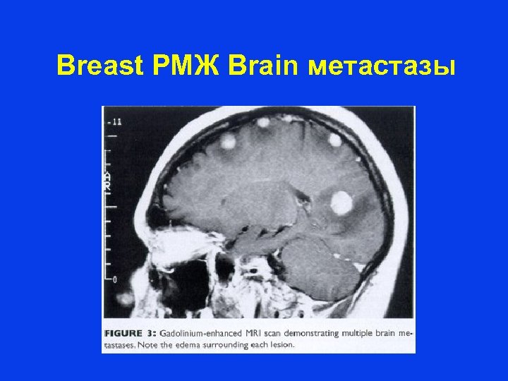 Breast РМЖ Brain метастазы 