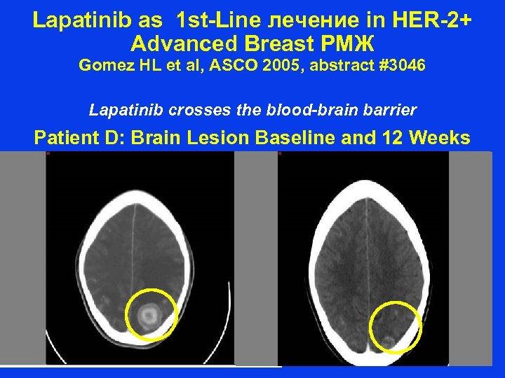 Lapatinib as 1 st-Line лечение in HER-2+ Advanced Breast РМЖ Gomez HL et al,