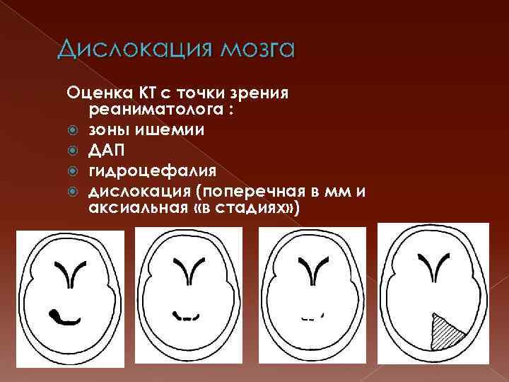 Дислокация мозга Оценка КТ с точки зрения реаниматолога : зоны ишемии ДАП гидроцефалия дислокация