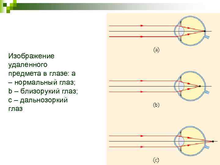 Изображение в близоруком глазу