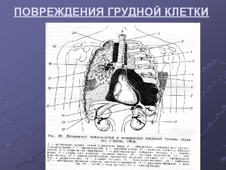 ПОВРЕЖДЕНИЯ ГРУДНОЙ КЛЕТКИ 