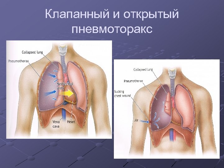 Клапанный и открытый пневмоторакс 