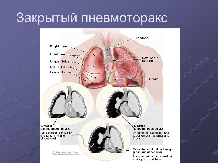 Повреждения органов грудной клетки презентация