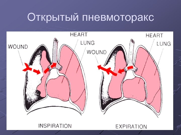 Открытый пневмоторакс 