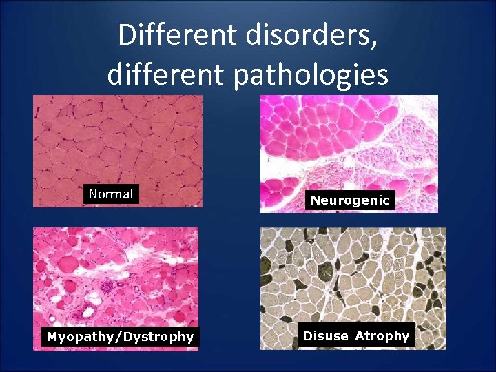 Different disorders, different pathologies Normal Myopathy/Dystrophy Neurogenic Disuse Atrophy 