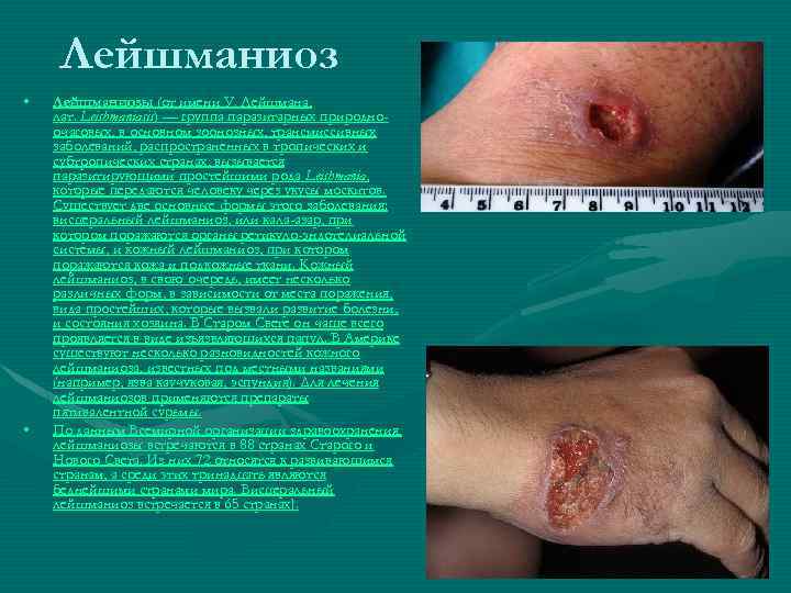 Лейшманиоз • • Лейшманиозы (от имени У. Лейшмана, лат. Leishmaniasis) — группа паразитарных природноочаговых,