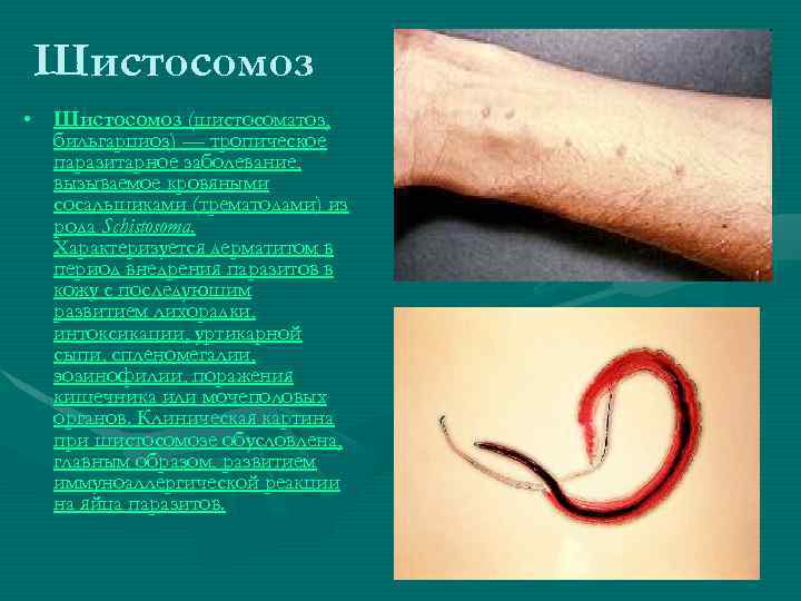 Шистосомоз • Шистосомоз (шистосоматоз, бильгарциоз) — тропическое паразитарное заболевание, вызываемое кровяными сосальщиками (трематодами) из