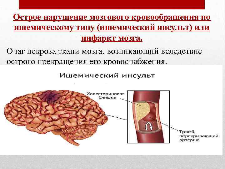 Острое нарушение мозгового кровообращения по ишемическому типу (ишемический инсульт) или инфаркт мозга. Очаг некроза