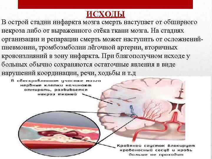 ИСХОДЫ В острой стадии инфаркта мозга смерть наступает от обширного некроза либо от выраженного