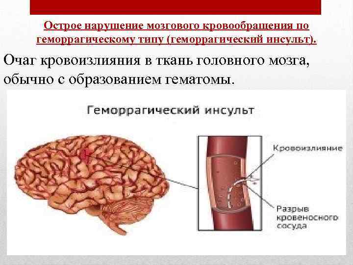 Острое нарушение мозгового кровообращения по геморрагическому типу (геморрагический инсульт). Очаг кровоизлияния в ткань головного