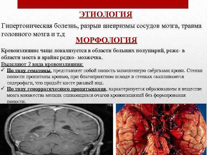 ЭТИОЛОГИЯ Гипертоническая болезнь, разрыв аневризмы сосудов мозга, травма головного мозга и т. д МОРФОЛОГИЯ