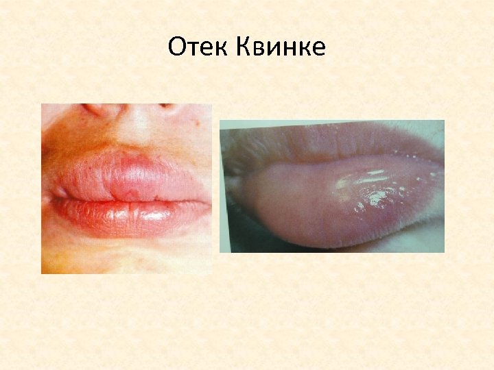 Отек Квинке 