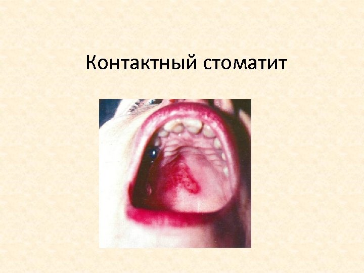 Контактный стоматит 