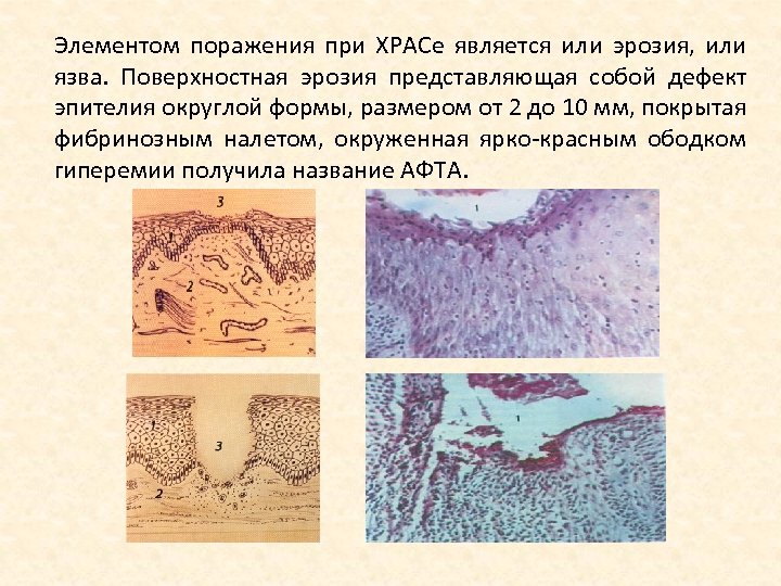 Элементом поражения при ХРАСе является или эрозия, или язва. Поверхностная эрозия представляющая собой дефект