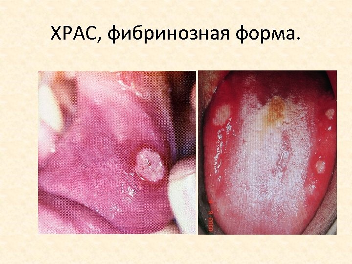 ХРАС, фибринозная форма. 