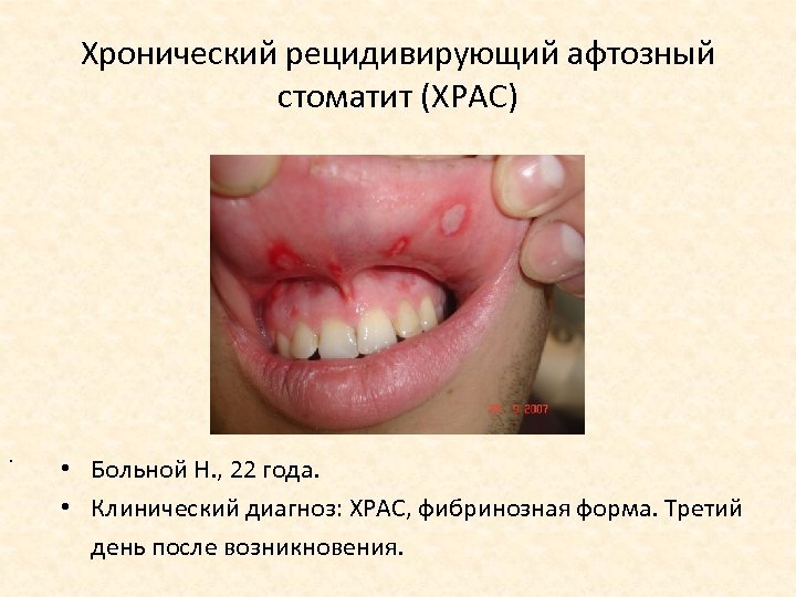 Хронический рецидивирующий афтозный стоматит (ХРАС) . • Больной Н. , 22 года. • Клинический